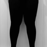 lipödem-före-efter