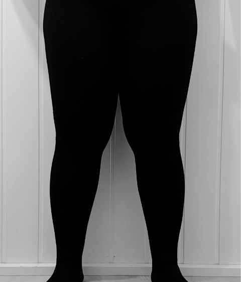 lipödem-före-efter