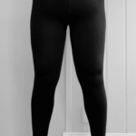 lipödem-före-efter